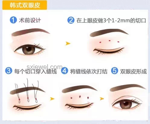 王安宇眼睛问题解决方案：改善视力与眼部健康